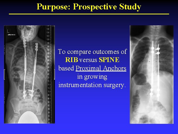 Purpose: Prospective Study To compare outcomes of RIB versus SPINE based Proximal Anchors in