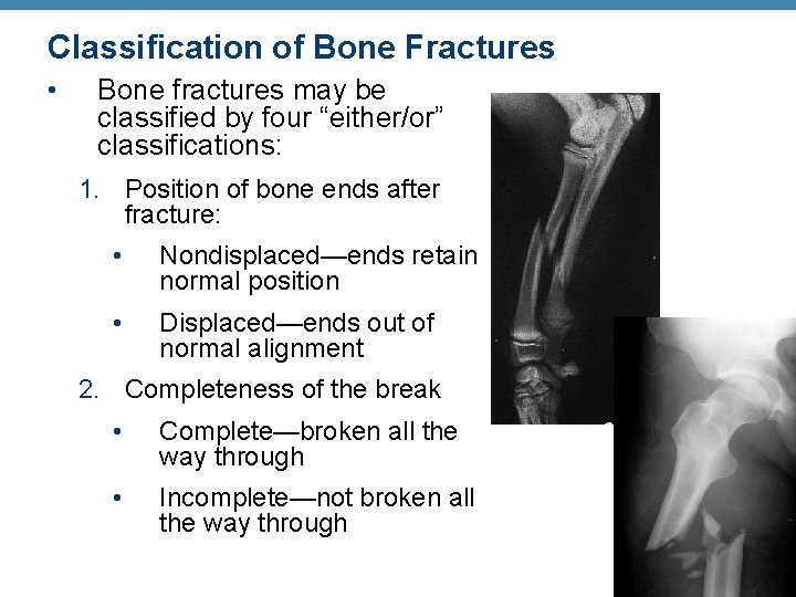 Classification of Bone Fractures • Bone fractures may be classified by four “either/or” classifications: