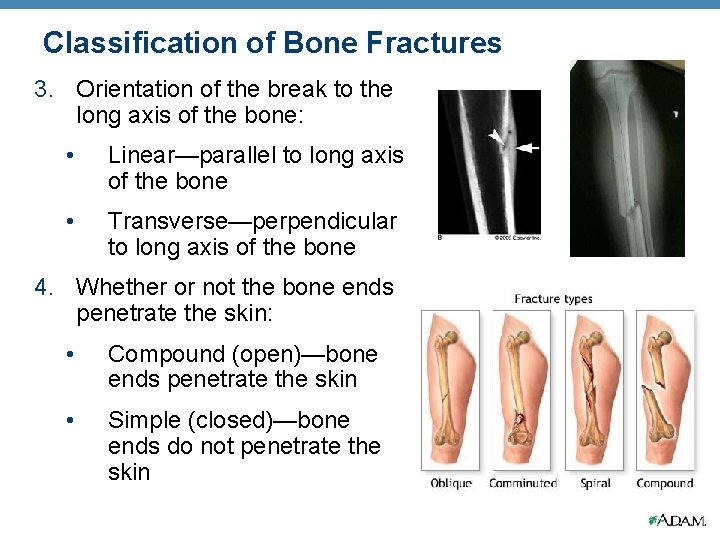 Classification of Bone Fractures 3. Orientation of the break to the long axis of