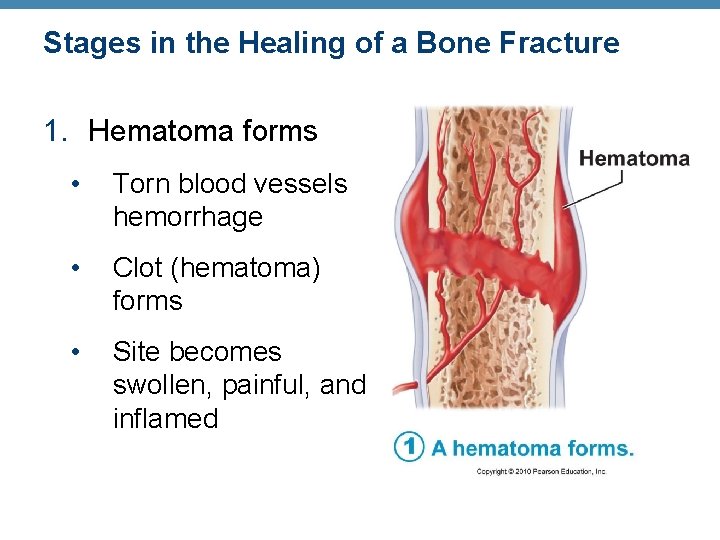 Stages in the Healing of a Bone Fracture 1. Hematoma forms • Torn blood