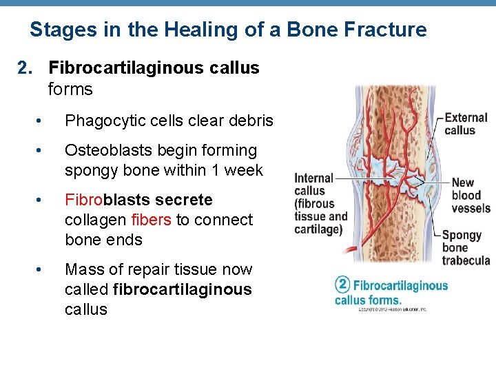 Stages in the Healing of a Bone Fracture 2. Fibrocartilaginous callus forms • Phagocytic