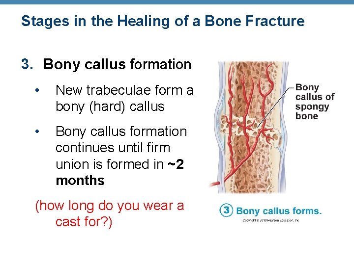 Stages in the Healing of a Bone Fracture 3. Bony callus formation • New