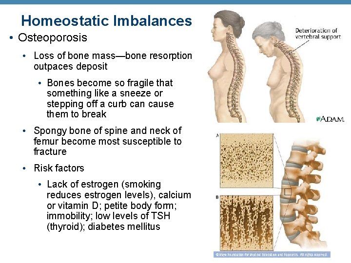Homeostatic Imbalances • Osteoporosis • Loss of bone mass—bone resorption outpaces deposit • Bones