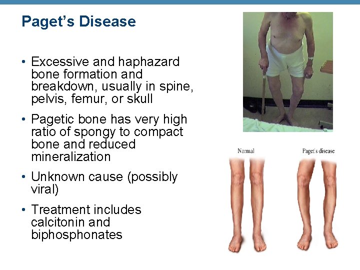 Paget’s Disease • Excessive and haphazard bone formation and breakdown, usually in spine, pelvis,