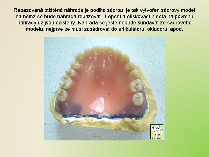 Rebazovaná otištěná náhrada je podlita sádrou, je tak vytvořen sádrový model na němž se