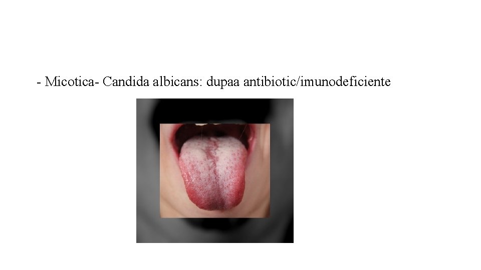 - Micotica- Candida albicans: dupaa antibiotic/imunodeficiente 