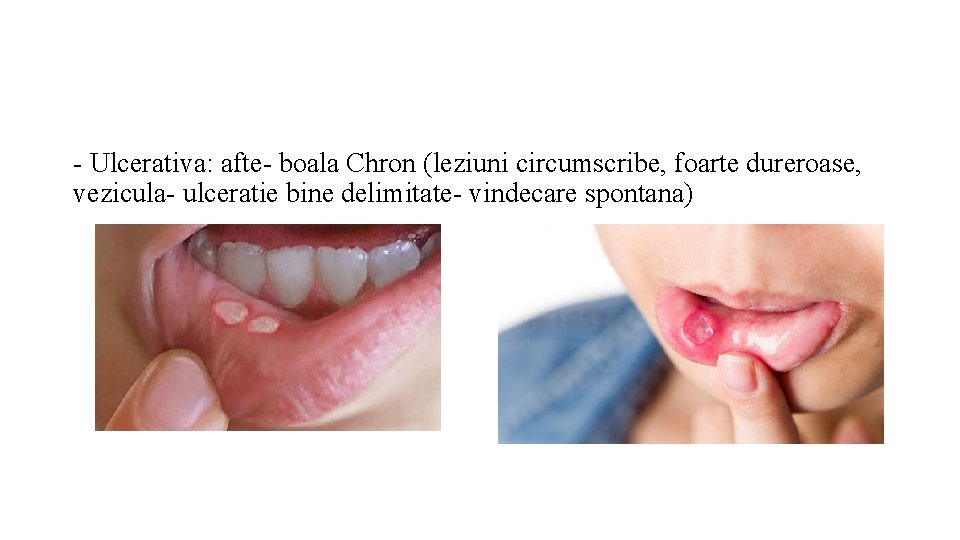 - Ulcerativa: afte- boala Chron (leziuni circumscribe, foarte dureroase, vezicula- ulceratie bine delimitate- vindecare
