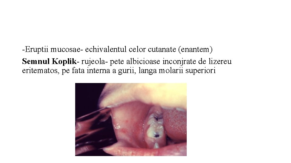 -Eruptii mucosae- echivalentul celor cutanate (enantem) Semnul Koplik- rujeola- pete albicioase inconjrate de lizereu
