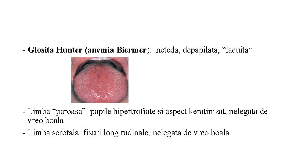- Glosita Hunter (anemia Biermer): neteda, depapilata, “lacuita” - Limba “paroasa”: papile hipertrofiate si