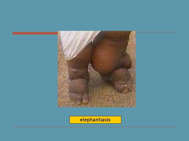 elephantiasis 