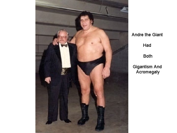 Andre the Giant Had Both Gigantism And Acromegaly 