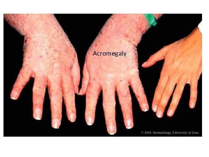 Acromegaly 