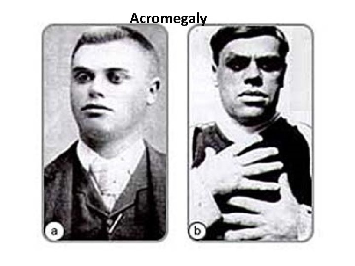 Acromegaly 