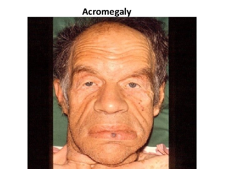 Acromegaly 