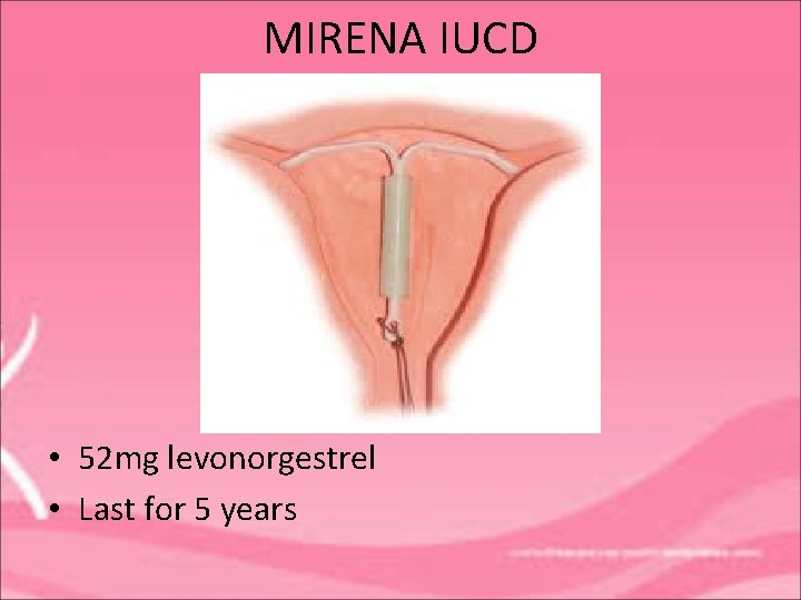 MIRENA IUCD • 52 mg levonorgestrel • Last for 5 years 