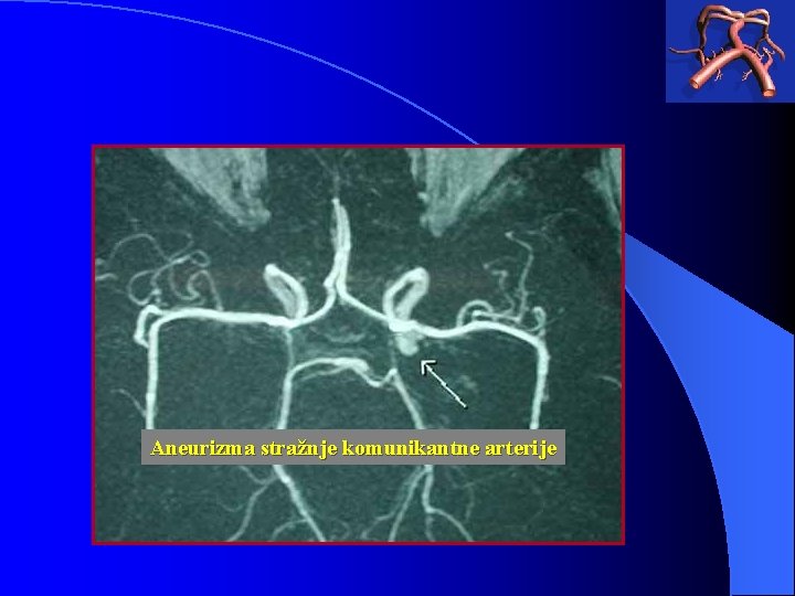 Aneurizma stražnje komunikantne arterije 