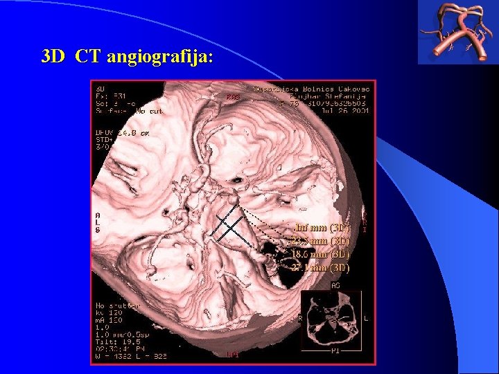 3 D CT angiografija: 