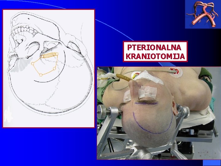 PTERIONALNA KRANIOTOMIJA 