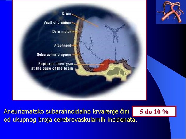 Aneurizmatsko subarahnoidalno krvarenje čini 5 do 10 % od ukupnog broja cerebrovaskularnih incidenata. 