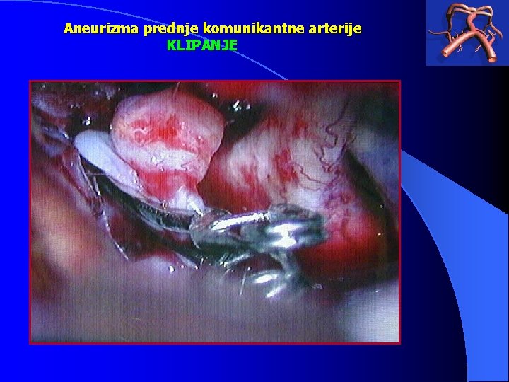 Aneurizma prednje komunikantne arterije KLIPANJE 