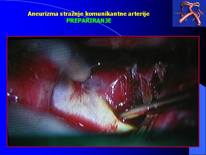 Aneurizma stražnje komunikantne arterije PREPARIRANJE 