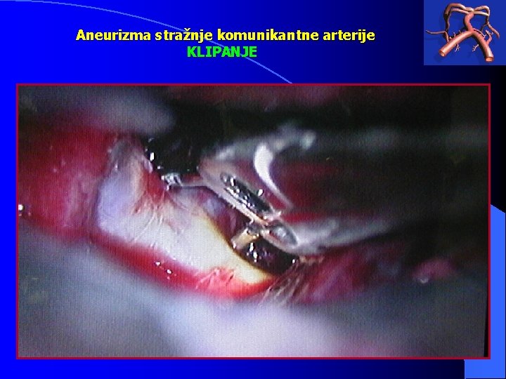 Aneurizma stražnje komunikantne arterije KLIPANJE 