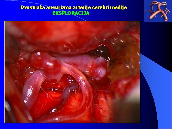 Dvostruka aneurizma arterije cerebri medije EKSPLORACIJA 