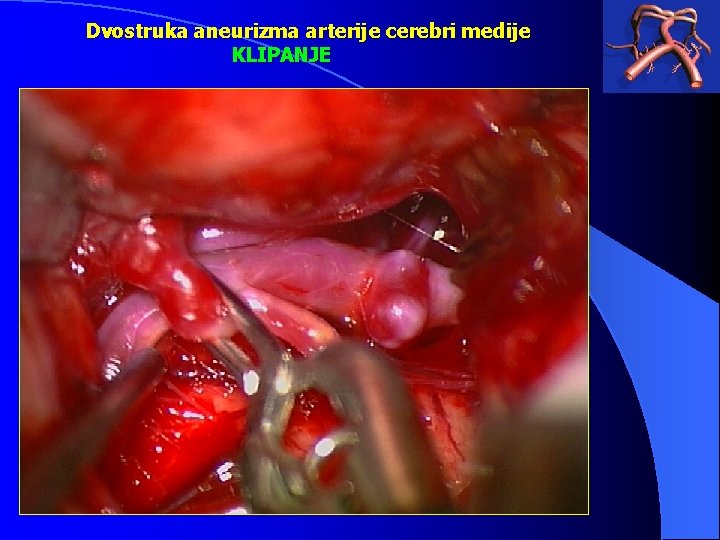 Dvostruka aneurizma arterije cerebri medije KLIPANJE 