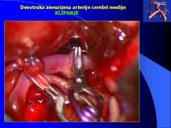 Dvostruka aneurizma arterije cerebri medije KLIPANJE 