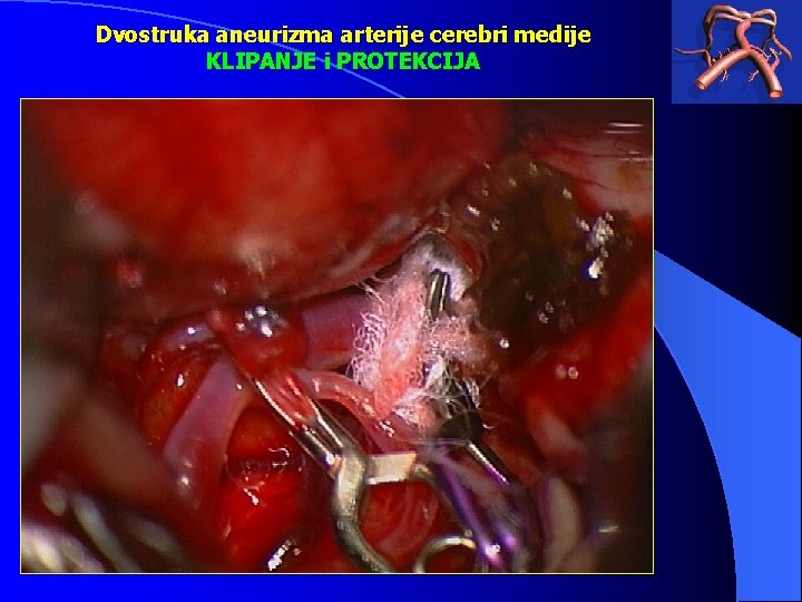 Dvostruka aneurizma arterije cerebri medije KLIPANJE i PROTEKCIJA 