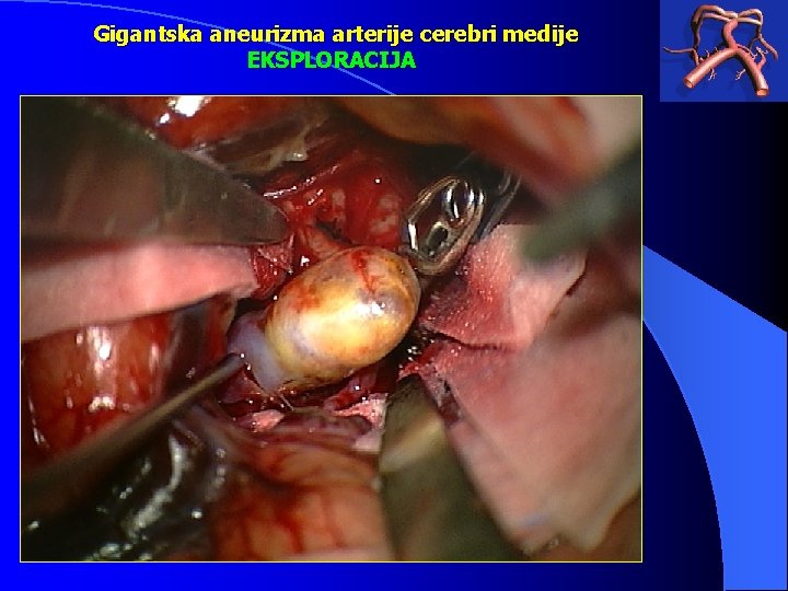 Gigantska aneurizma arterije cerebri medije EKSPLORACIJA 