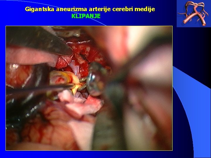 Gigantska aneurizma arterije cerebri medije KLIPANJE 