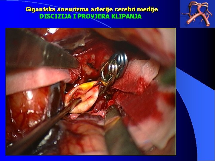 Gigantska aneurizma arterije cerebri medije DISCIZIJA I PROVJERA KLIPANJA 