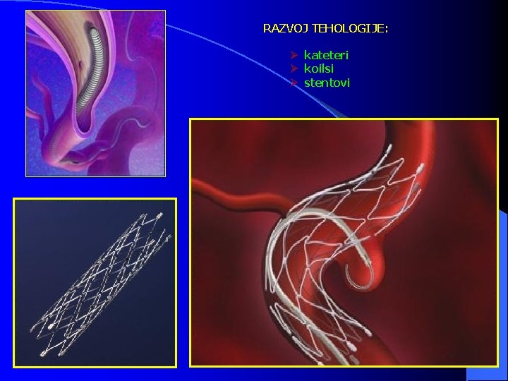 RAZVOJ TEHOLOGIJE: Ø Ø Ø kateteri koilsi stentovi 