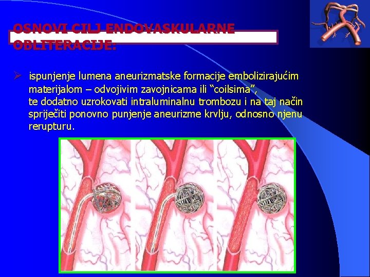 OSNOVI CILJ ENDOVASKULARNE OBLITERACIJE: Ø ispunjenje lumena aneurizmatske formacije embolizirajućim materijalom – odvojivim zavojnicama