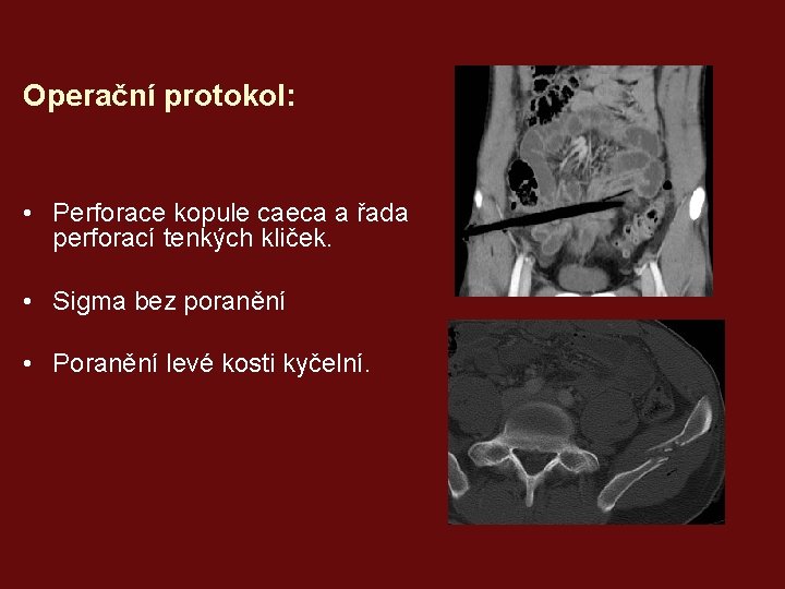 Operační protokol: • Perforace kopule caeca a řada perforací tenkých kliček. • Sigma bez