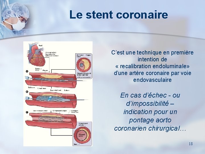 Le stent coronaire C’est une technique en première intention de « recalibration endoluminale» d’une
