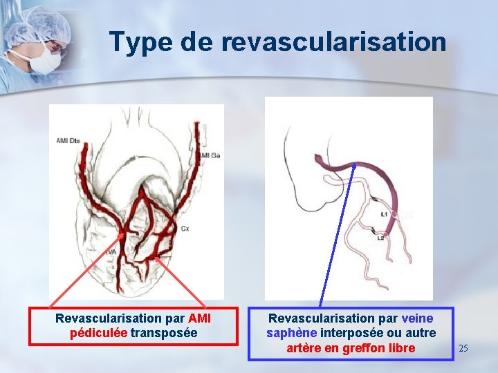 Type de revascularisation Revascularisation par AMI pédiculée transposée Revascularisation par veine saphène interposée ou