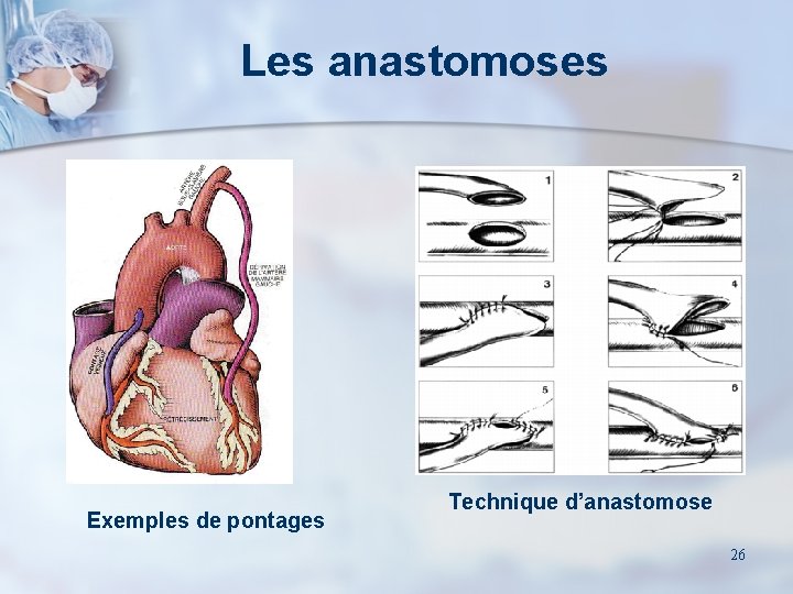 Les anastomoses Exemples de pontages Technique d’anastomose 26 