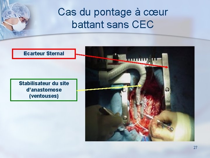 Cas du pontage à cœur battant sans CEC Ecarteur Sternal Stabilisateur du site d’anastomose