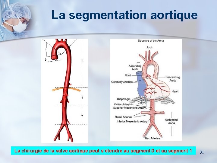 La segmentation aortique La chirurgie de la valve aortique peut s’étendre au segment 0