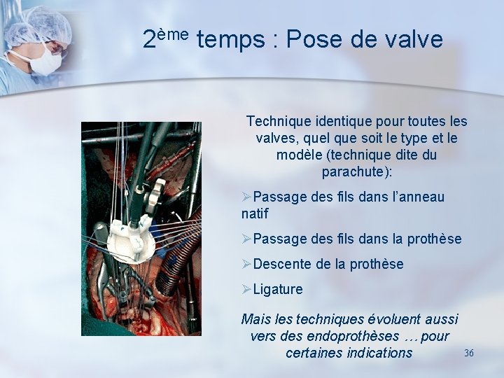 2ème temps : Pose de valve Technique identique pour toutes les valves, quel que