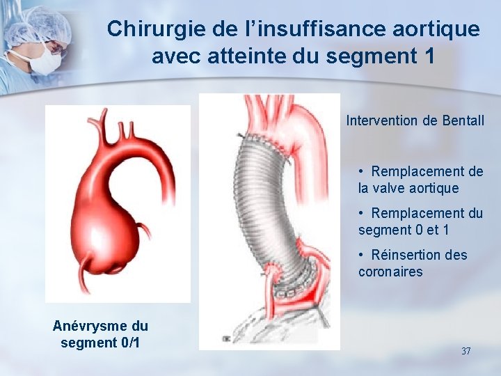 Chirurgie de l’insuffisance aortique avec atteinte du segment 1 Intervention de Bentall • Remplacement