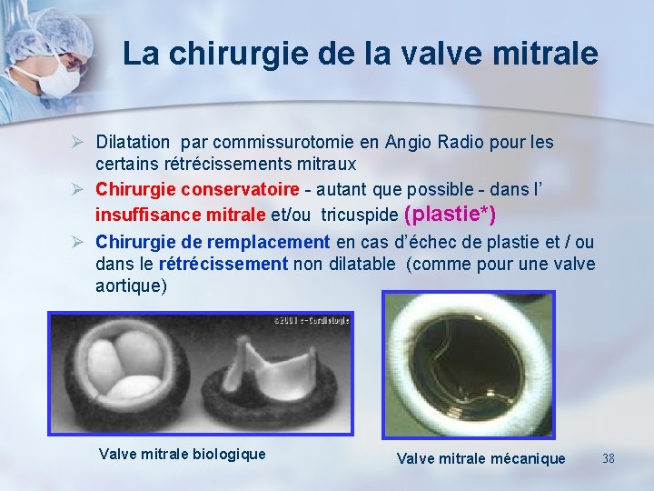 La chirurgie de la valve mitrale Ø Dilatation par commissurotomie en Angio Radio pour
