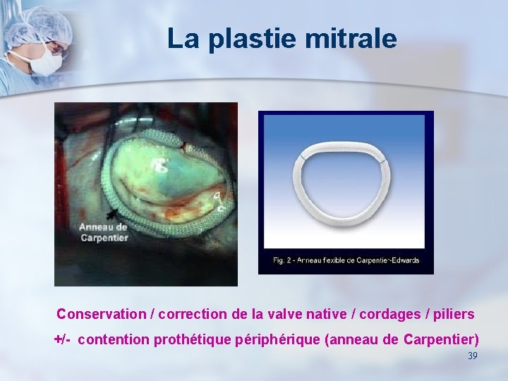 La plastie mitrale Conservation / correction de la valve native / cordages / piliers