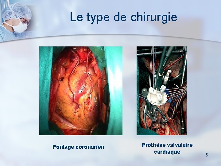 Le type de chirurgie Pontage coronarien Prothèse valvulaire cardiaque 5 