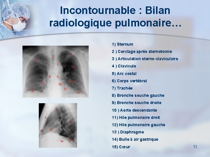 Incontournable : Bilan radiologique pulmonaire… 1) Sternum 2 ) Cerclage après sternotomie 3 )