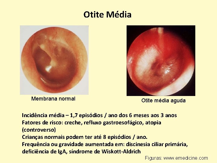 Otite Média Membrana normal Otite média aguda Incidência média – 1, 7 episódios /