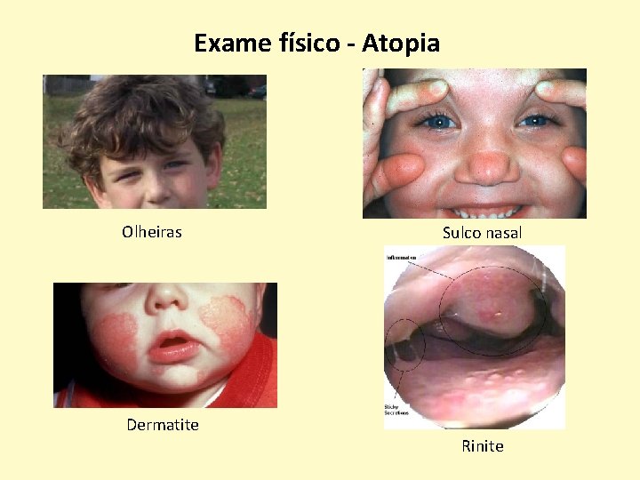 Exame físico - Atopia Olheiras Dermatite Sulco nasal Rinite 