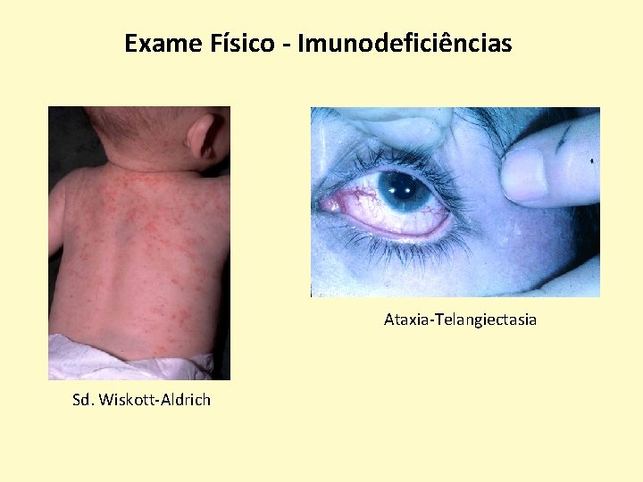 Exame Físico - Imunodeficiências Ataxia-Telangiectasia Sd. Wiskott-Aldrich 